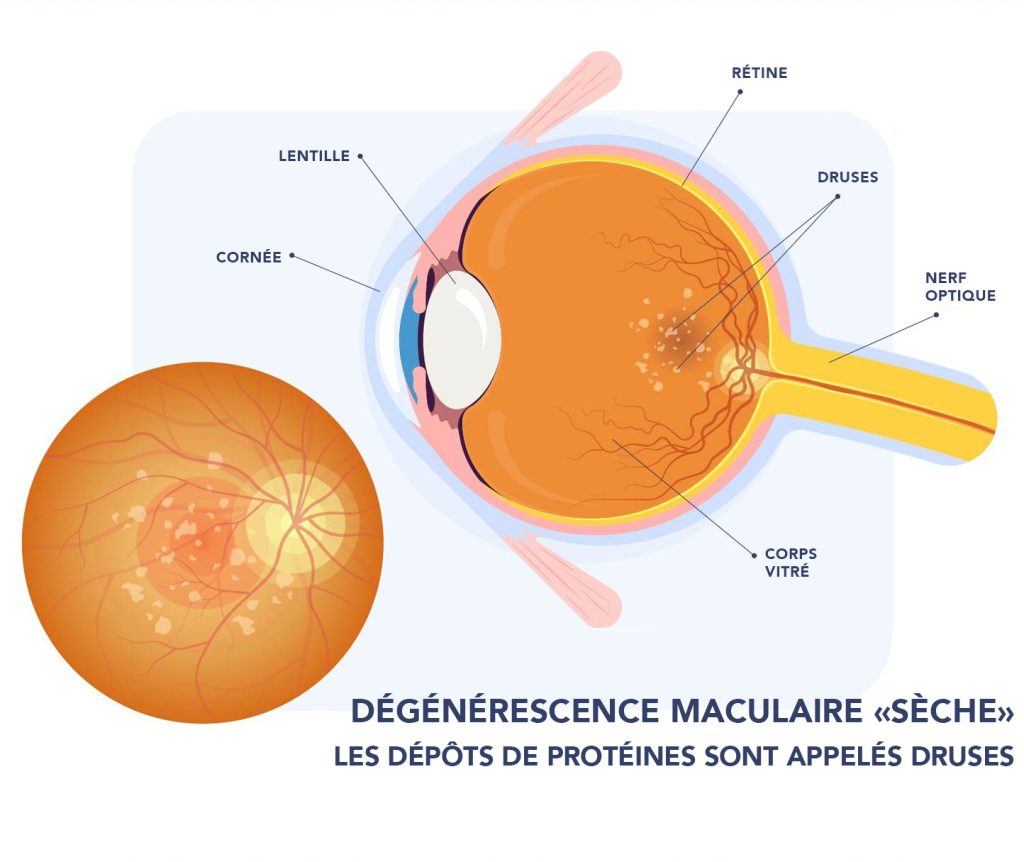 Diagramme d'un oeil atteint de la dégénérescence sèche montrant des dépôts de protéines au niveau de la macula, appelés des druses