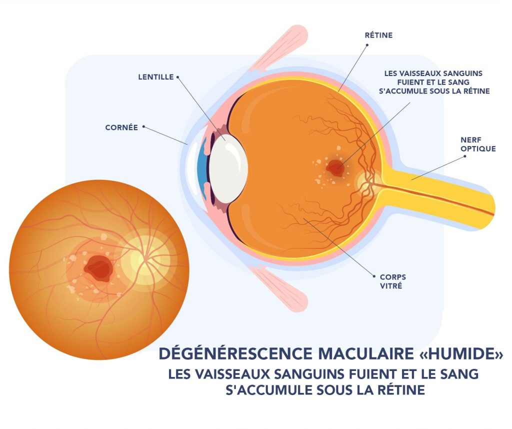 Diagramme d'un oeil atteint de la dégénérescence humide montrant des vaisseaux sanguins qui fuient et le sang qui s'accumule sous la rétine